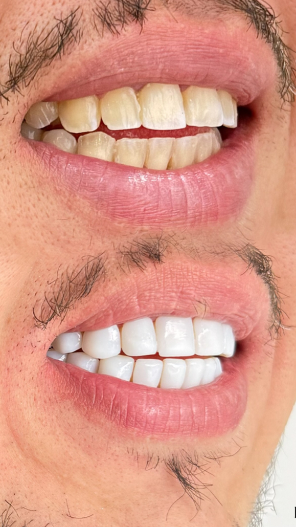 Antes e Depois