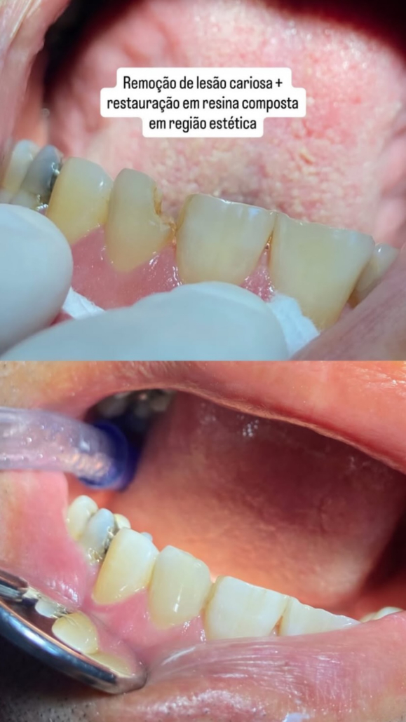 Antes e Depois