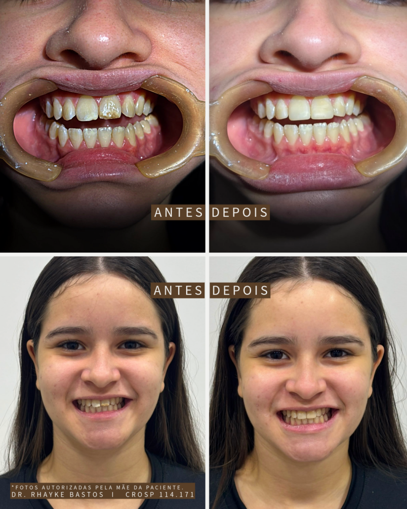 Antes e Depois
