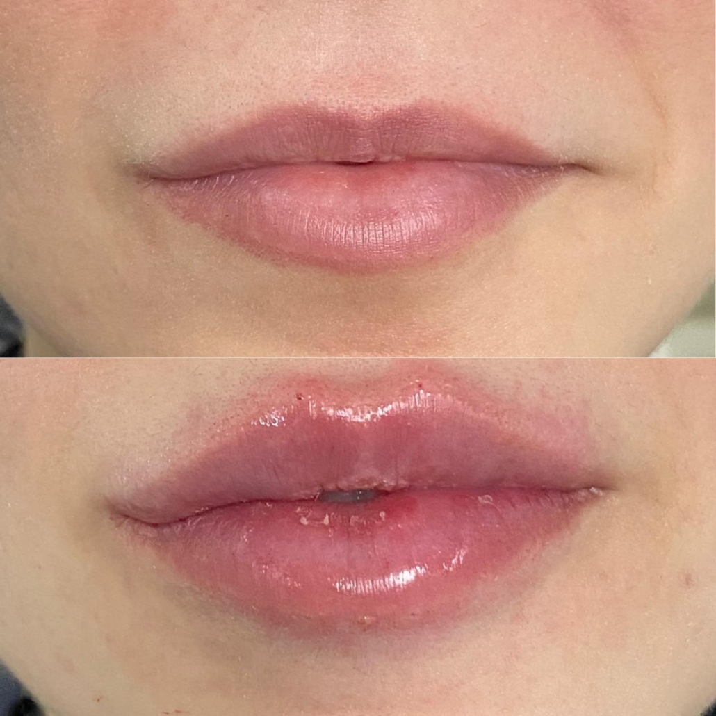Antes e Depois