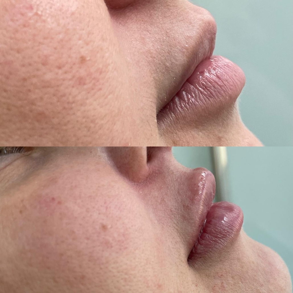 Antes e Depois