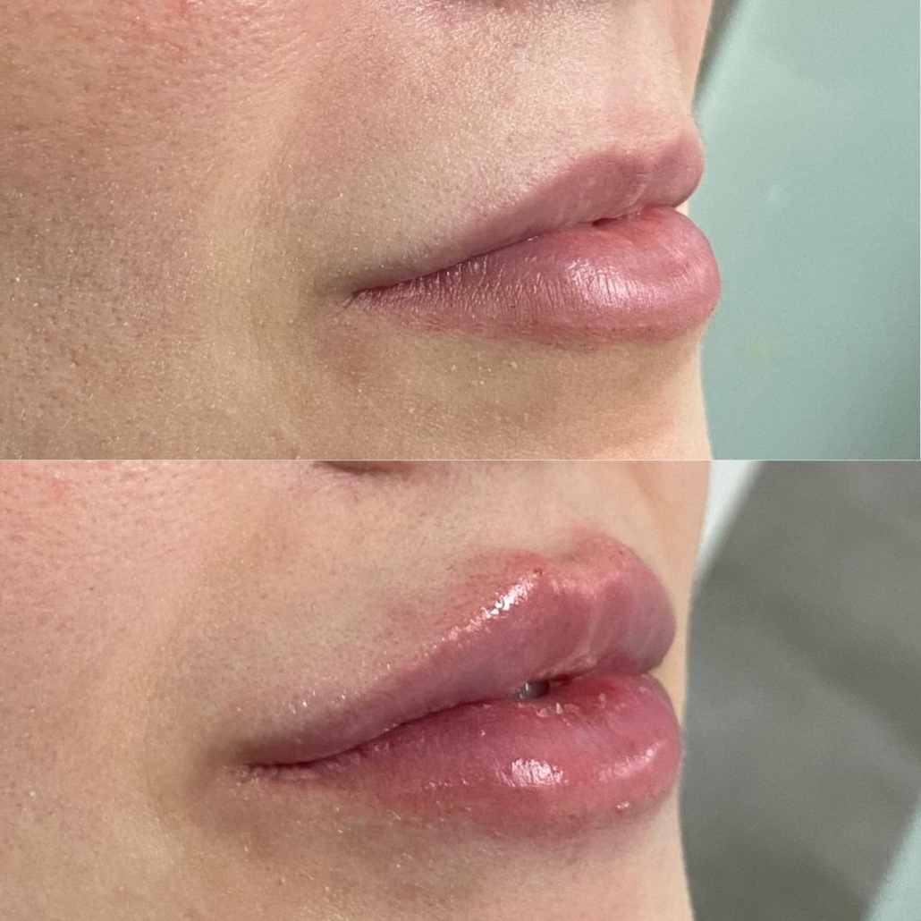 Antes e Depois