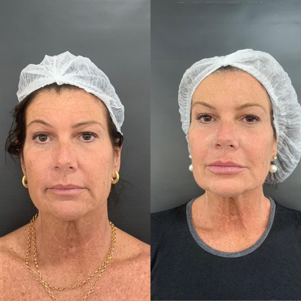 Antes e Depois