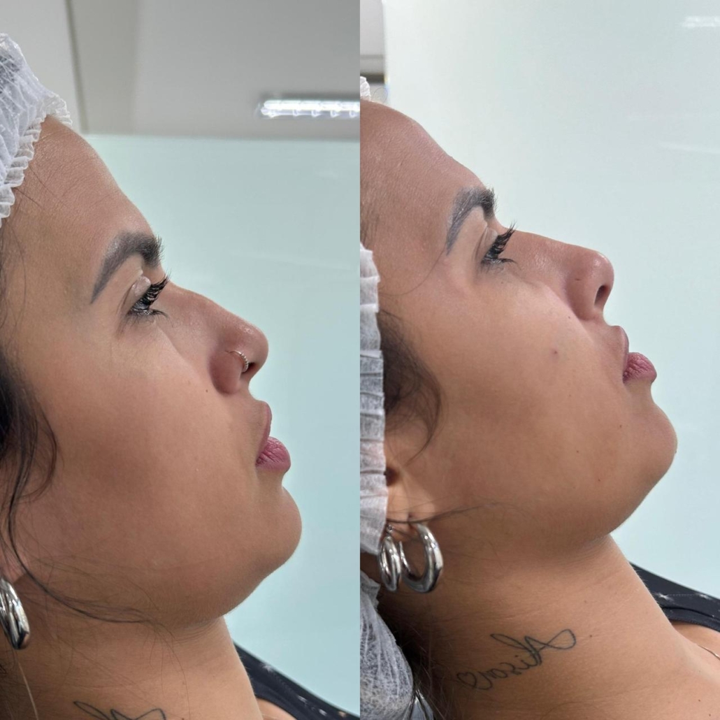 Antes e Depois