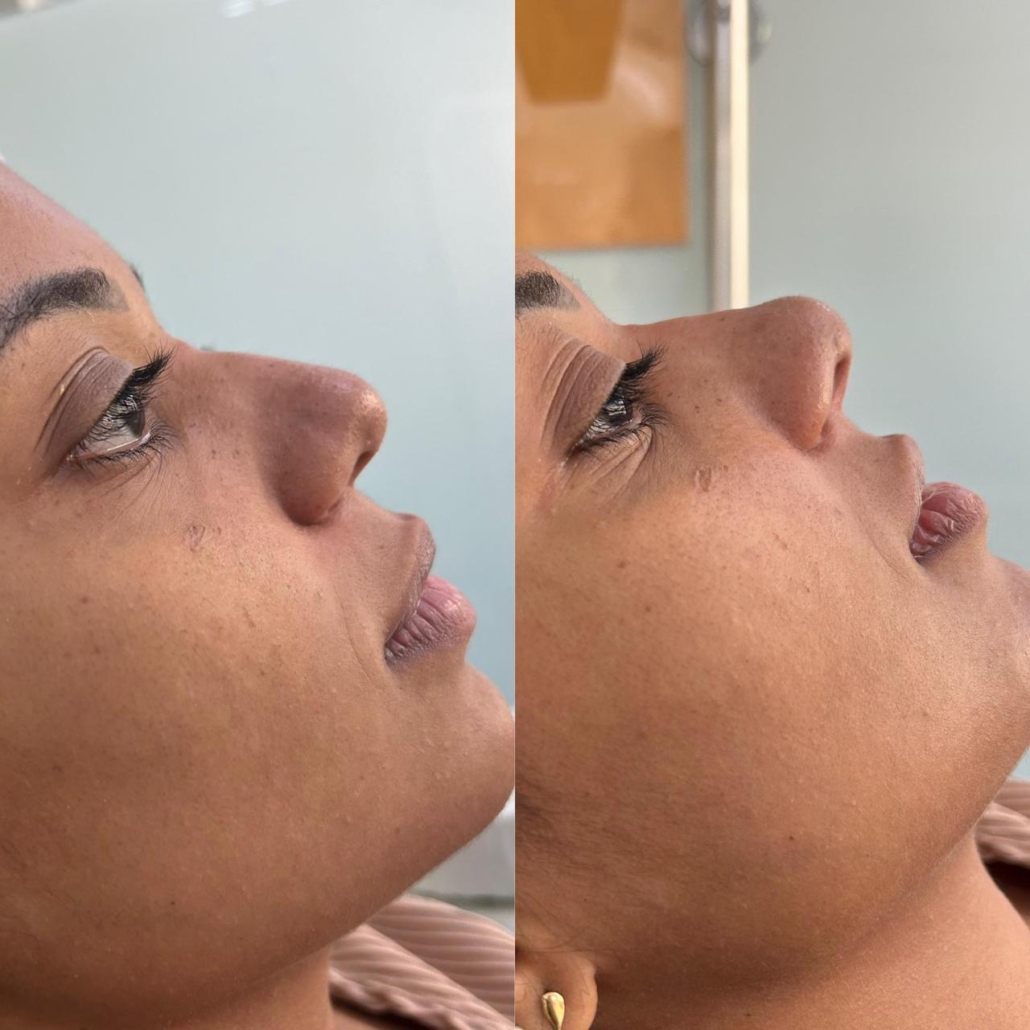 Antes e Depois