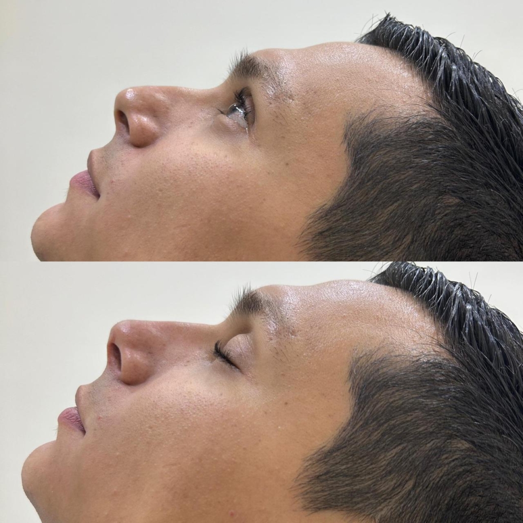 Antes e Depois