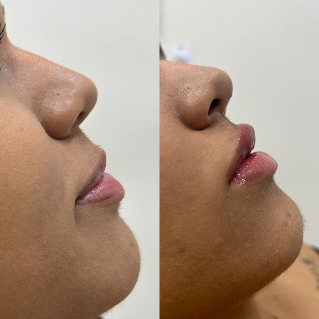 Antes e Depois