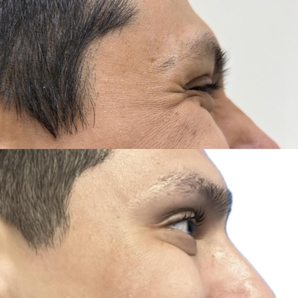 Antes e Depois