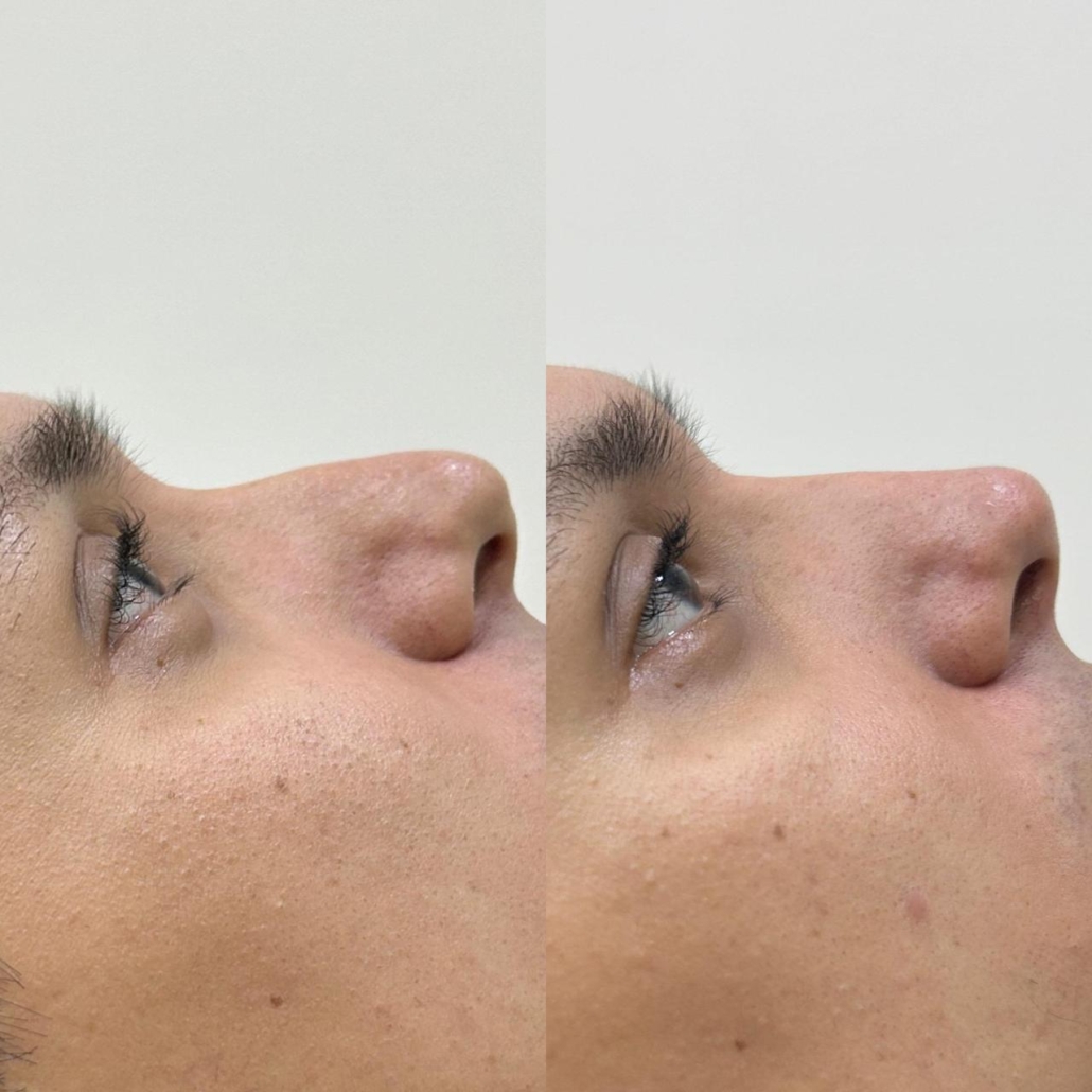 Antes e Depois