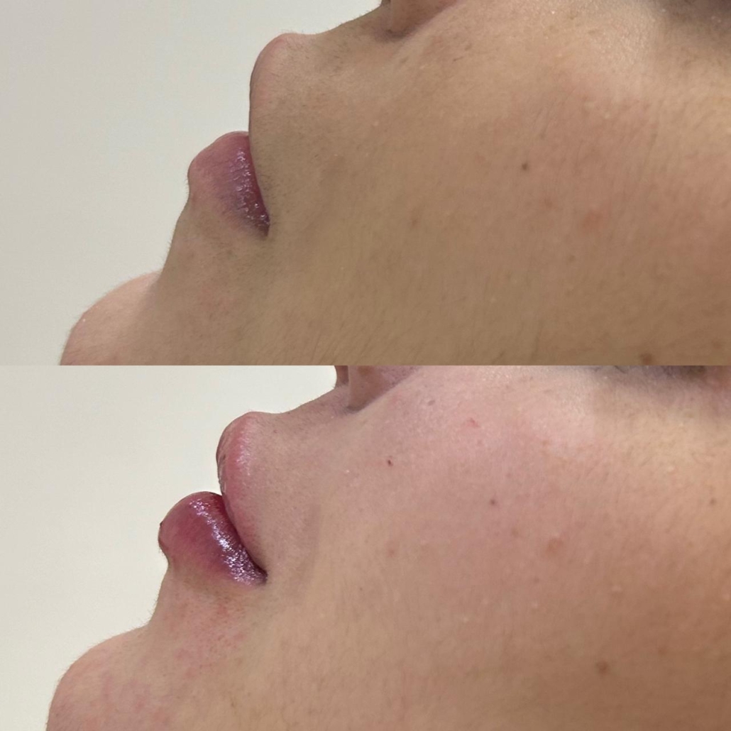 Antes e Depois