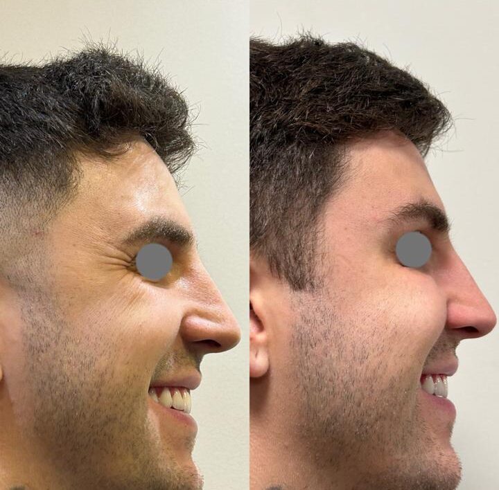 Antes e Depois