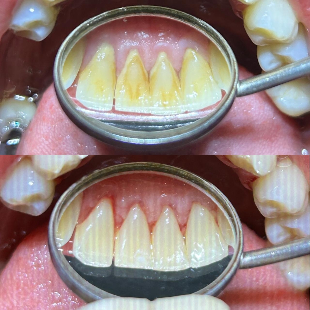 Antes e Depois