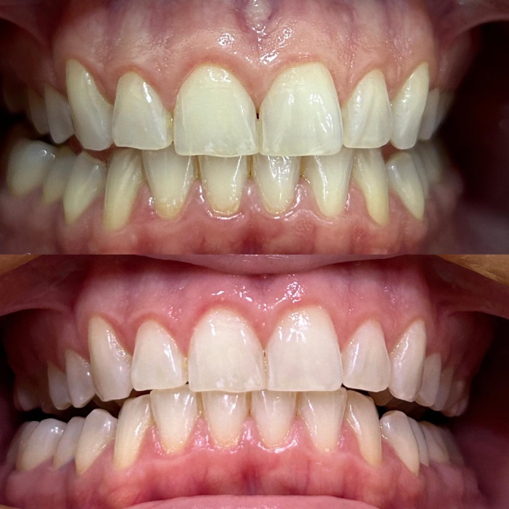 Antes e Depois