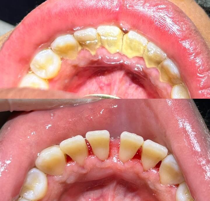 Antes e Depois